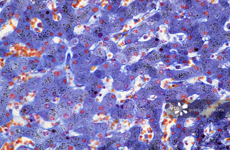 含铁血黄素沉着症显微镜图片素材