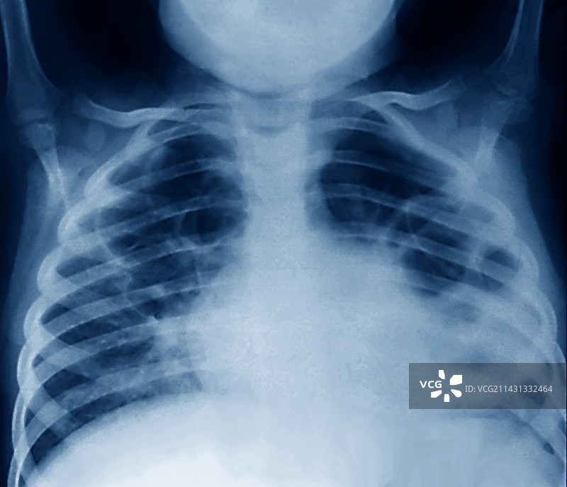 肺炎X光片图片素材