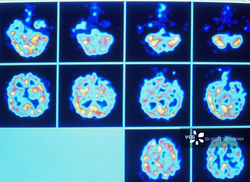 精神分裂症患者的PET扫描序列图片素材