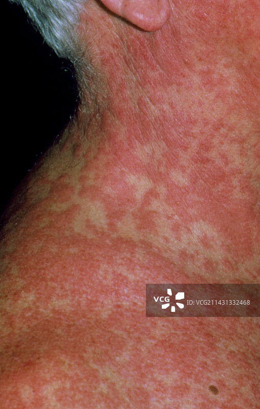 药物反应引起的广泛皮疹图片素材