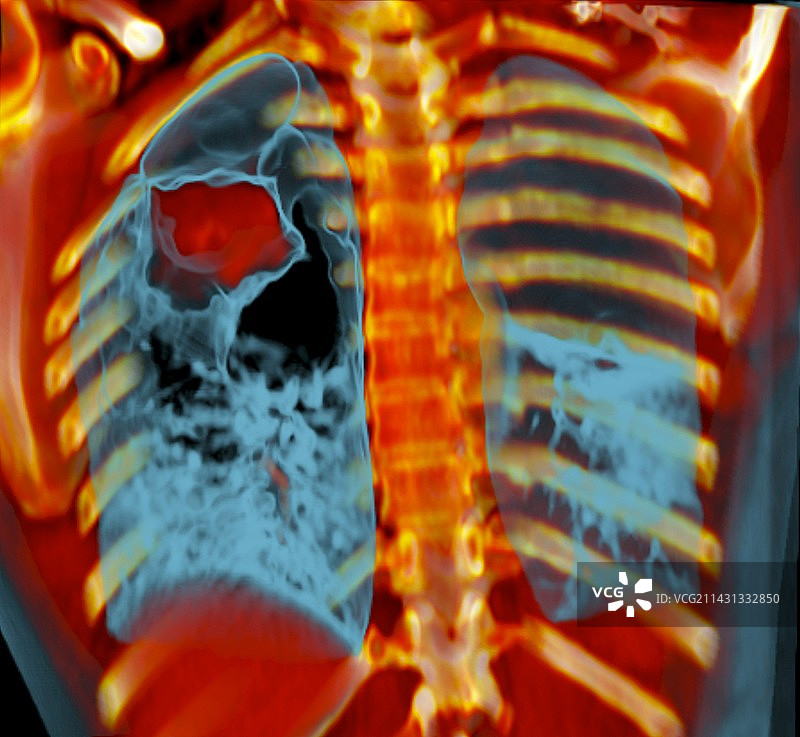 肺癌CT扫描图片素材
