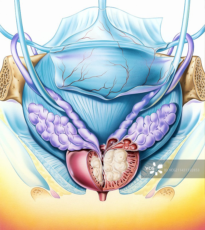 良性前列腺增生，艺术作品图片素材