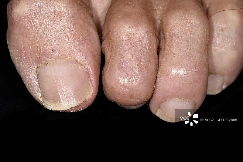 先天性锤状趾图片素材