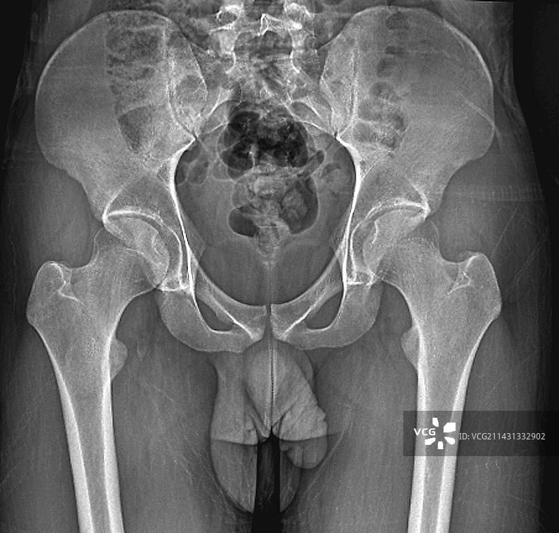 男性骨盆骨骼和关节X光片图片素材