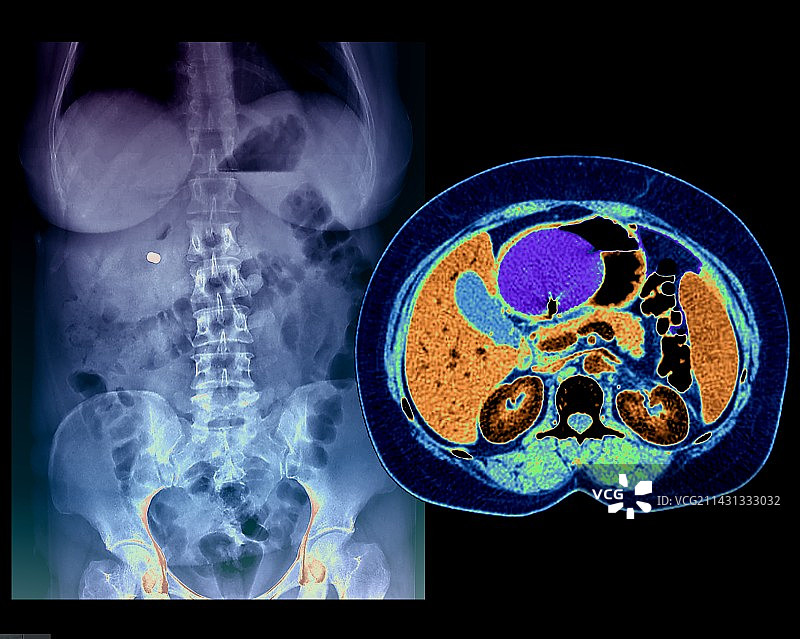 胃球囊，CT扫描图片素材