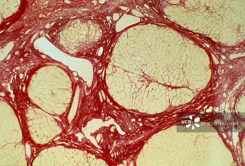 显示肝硬化的肝组织光镜图图片素材