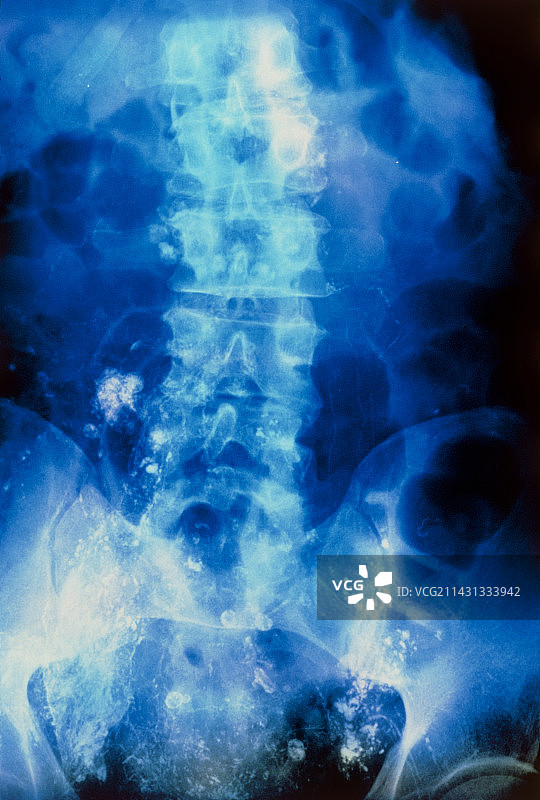 淋巴瘤腹部淋巴管造影伪彩色图图片素材