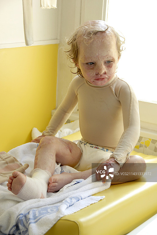 烧伤治疗图片素材