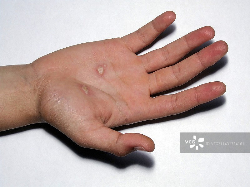 电烧伤图片素材