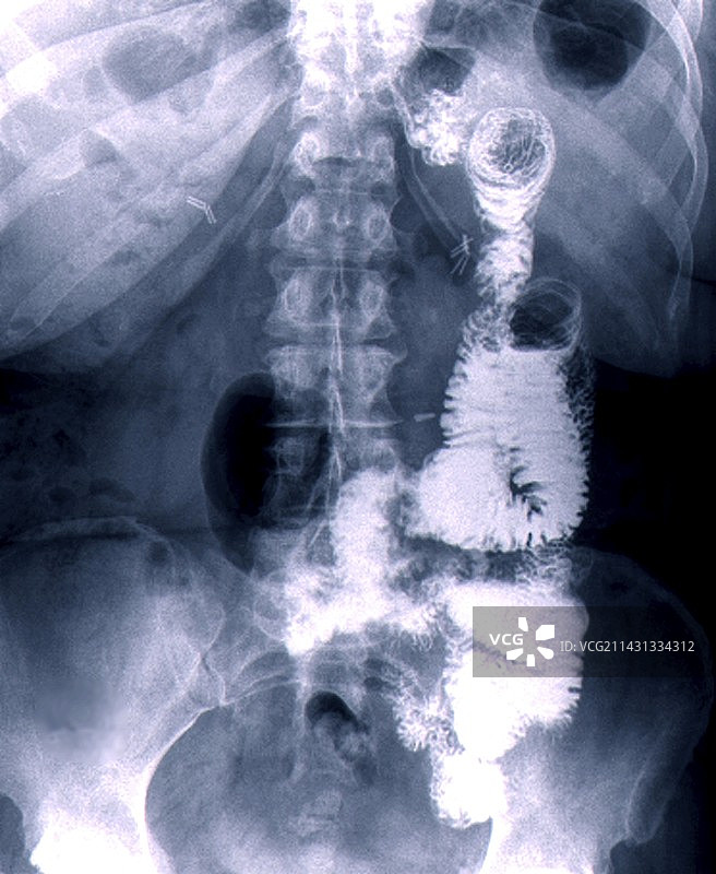胃旁路手术X光片图片素材