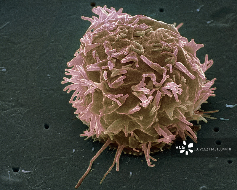 乳腺癌细胞扫描电镜图图片素材