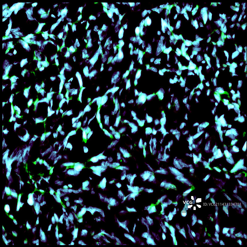 神经胶质瘤癌细胞中的纳米颗粒显微照片图片素材