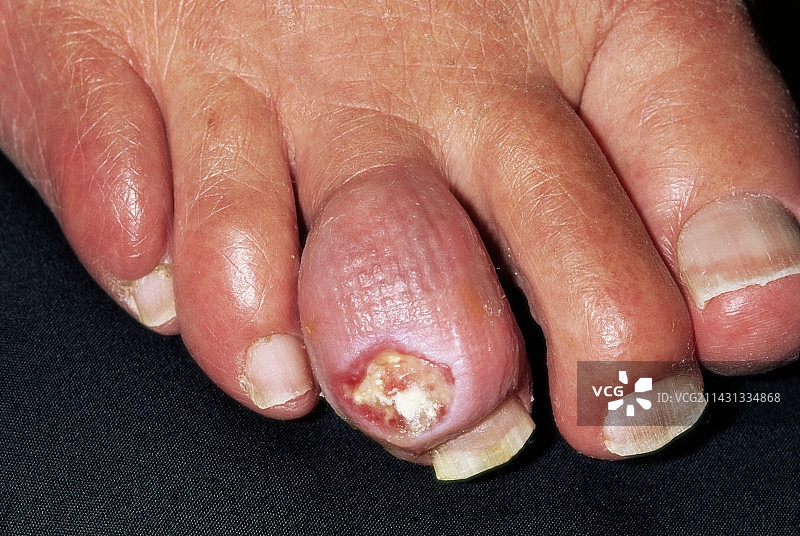 溃疡性痛风石图片素材