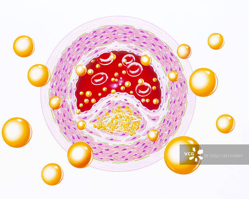 高脂血症中狭窄动脉插画图片素材