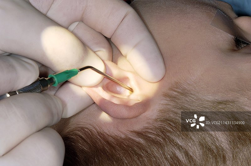 耳膜置管术图片素材