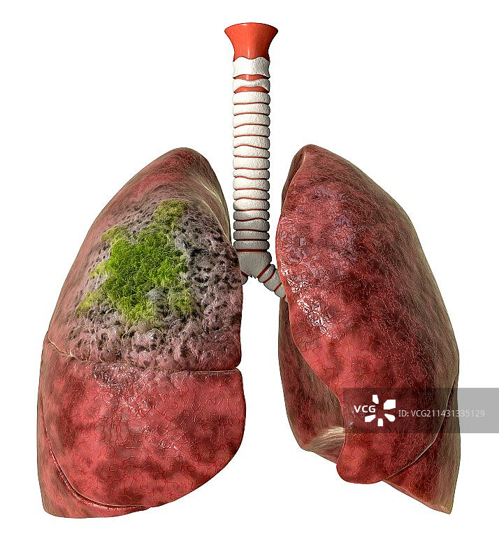 肺癌艺术作品图片素材