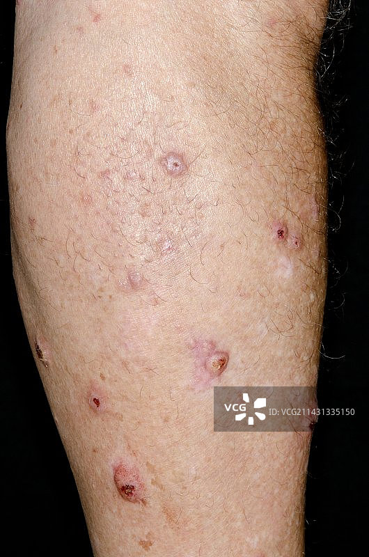 皮肤上的结节性痒疹图片素材