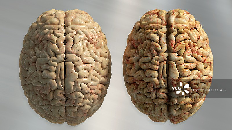 健康的大脑与阿尔茨海默症大脑插图图片素材