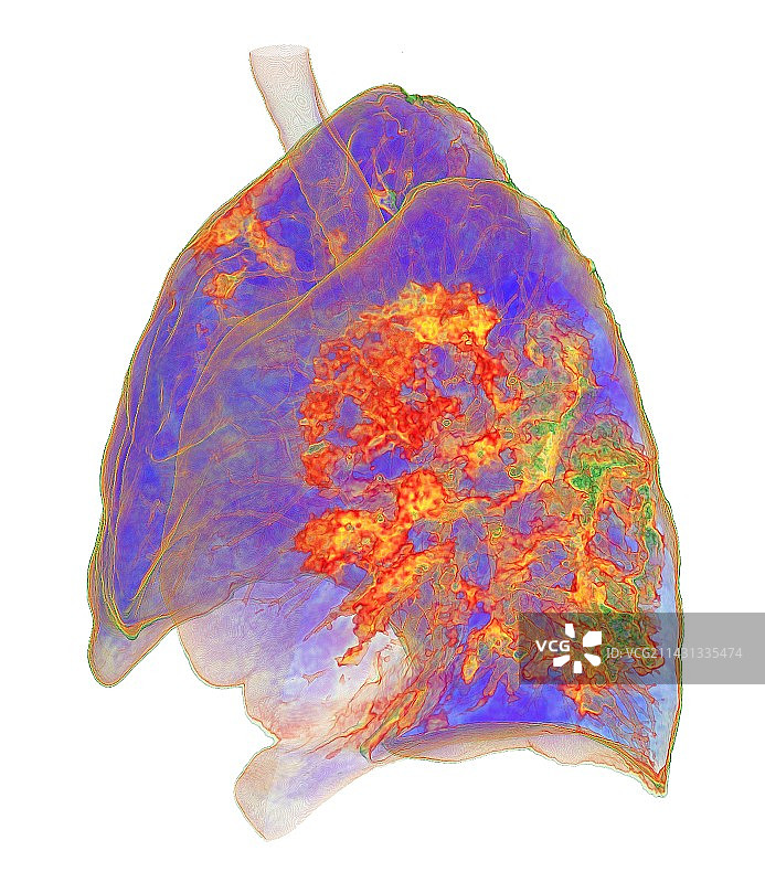 受新冠影响的肺部非典型肺炎3D CT扫描图片素材