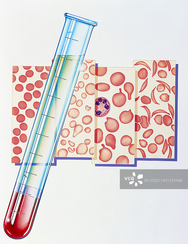 血细胞与贫血类型图片素材