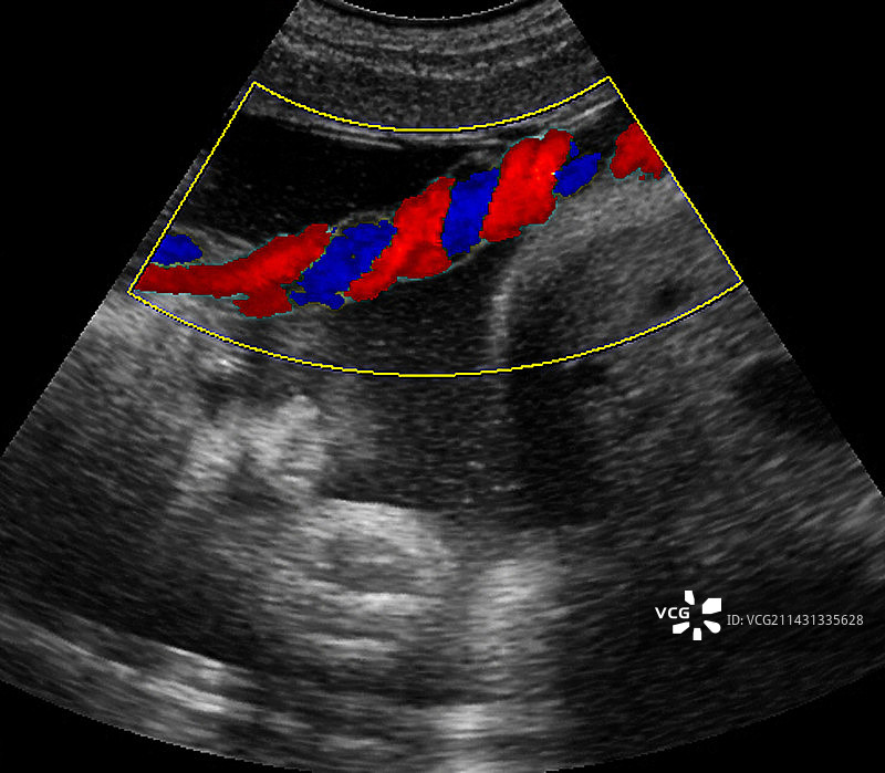 脐带血流超声波图片素材