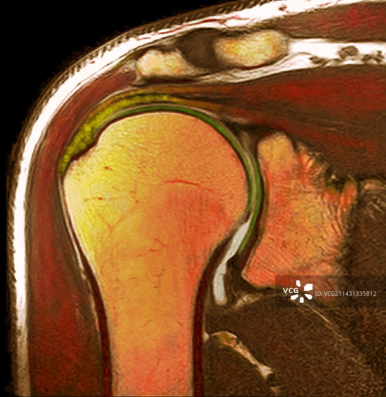 肩关节核磁共振扫描图片素材