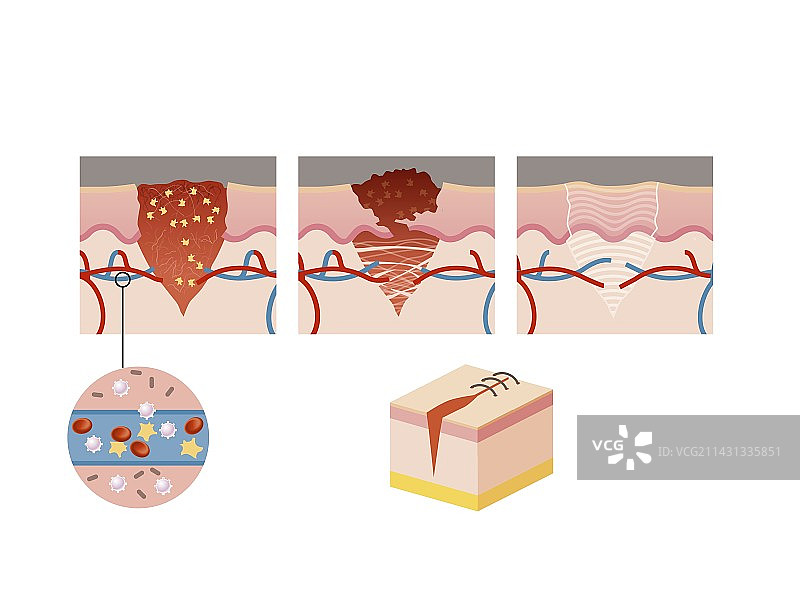 伤口愈合插图图片素材