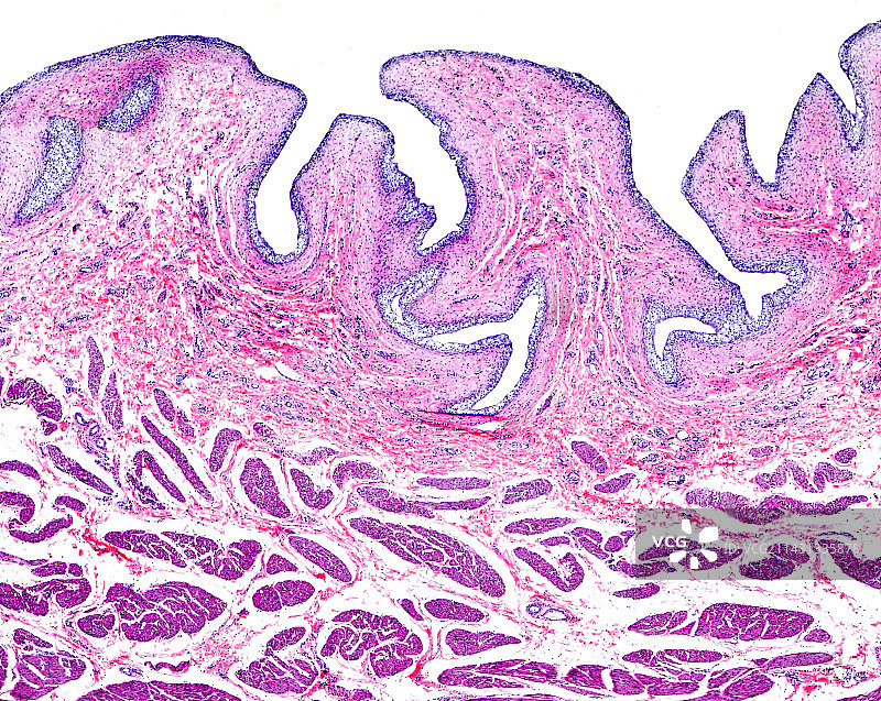 转移性上皮膀胱癌显微照片图片素材