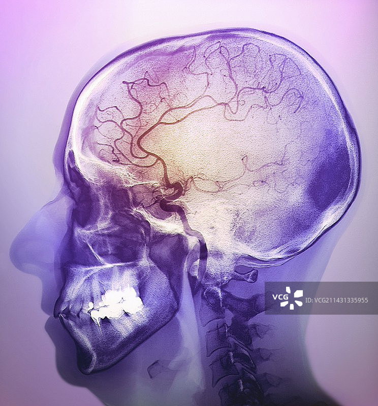 中风血管造影图片素材