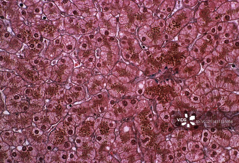 肝功能衰竭图片素材