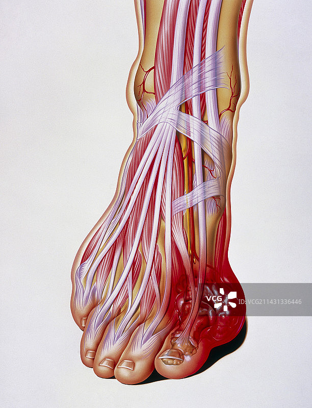痛风示意图：大脚趾底部痛风石图片素材