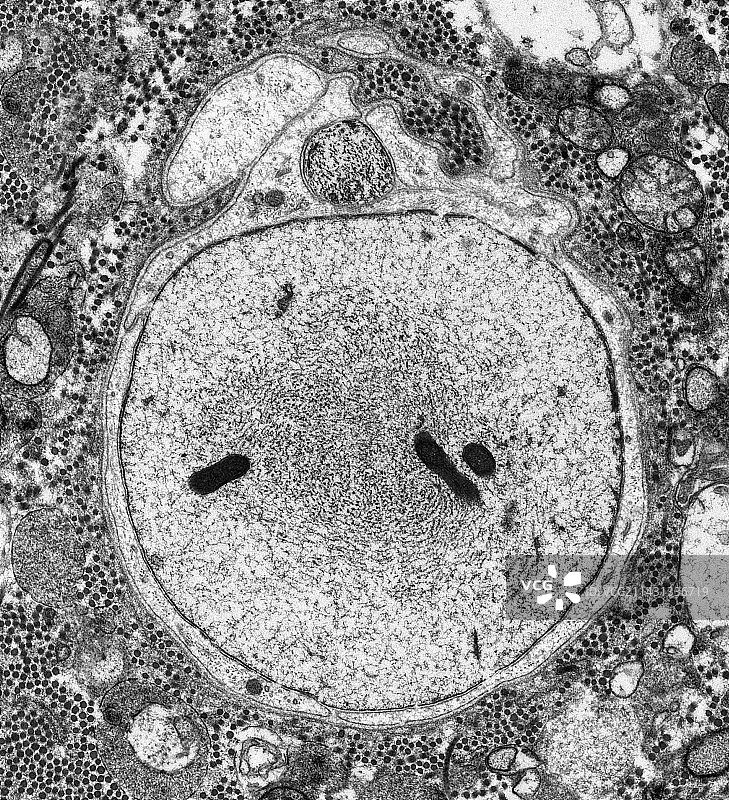 多发性硬化症中脱髓鞘神经，透射电镜图片素材