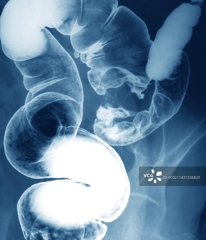 结肠癌图片素材