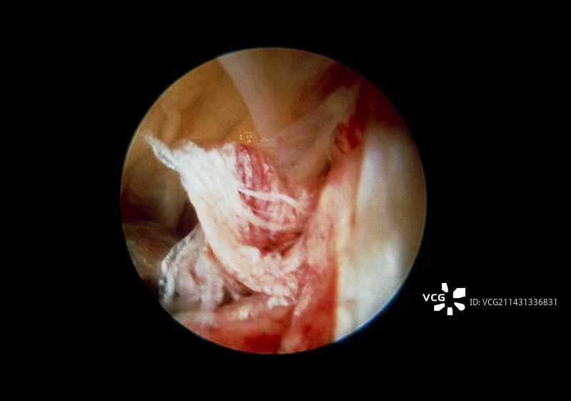 膝盖韧带撕裂图片素材