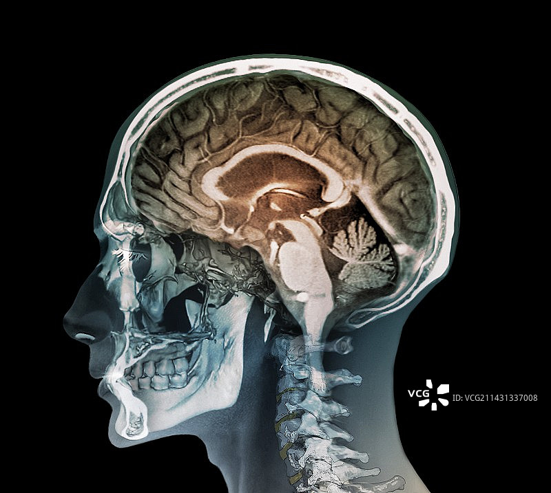 人头部的MRI和3D CT扫描图片素材
