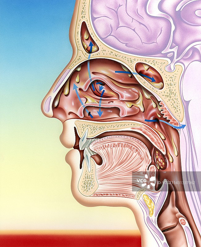 上呼吸道感染图片素材