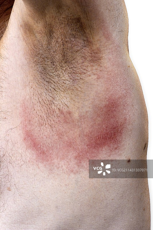 过敏性接触皮炎图片素材