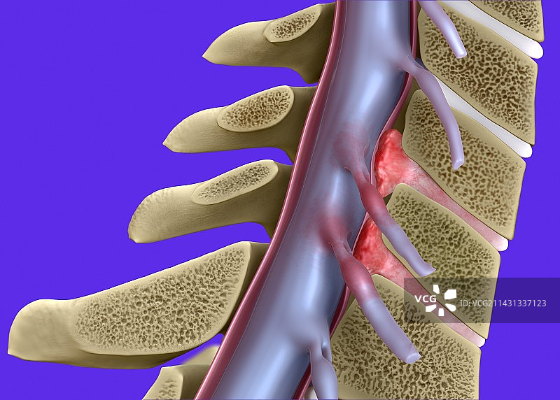 颈部挥鞭伤插图图片素材