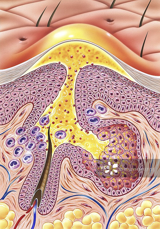 痤疮，插图图片素材