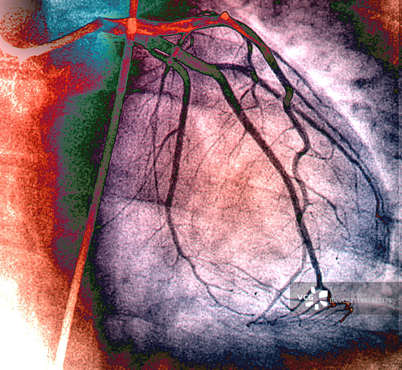 正常左冠状动脉网络血管造影图片素材