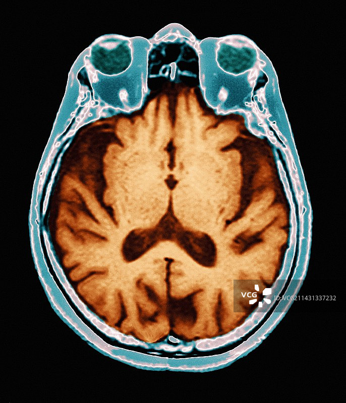 阿尔茨海默病MRI脑部扫描图片素材