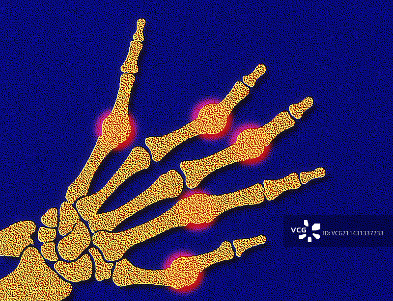 关节炎手部图片素材