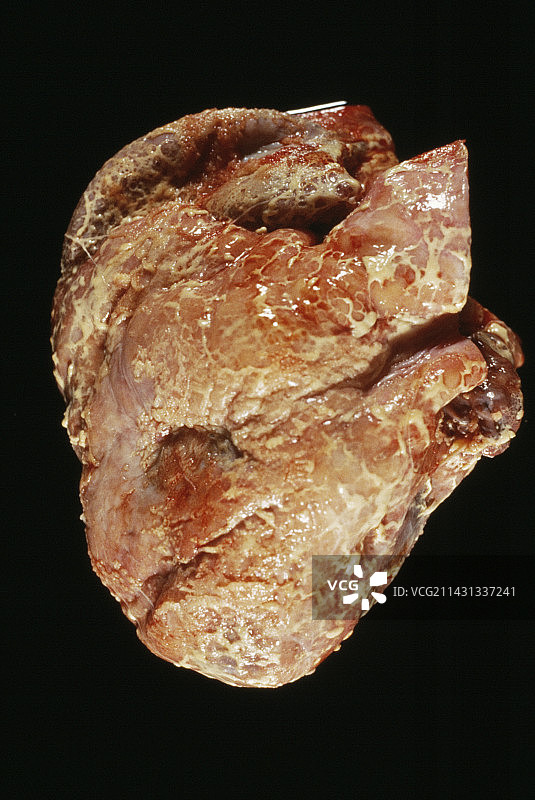 心脏疾病图片素材