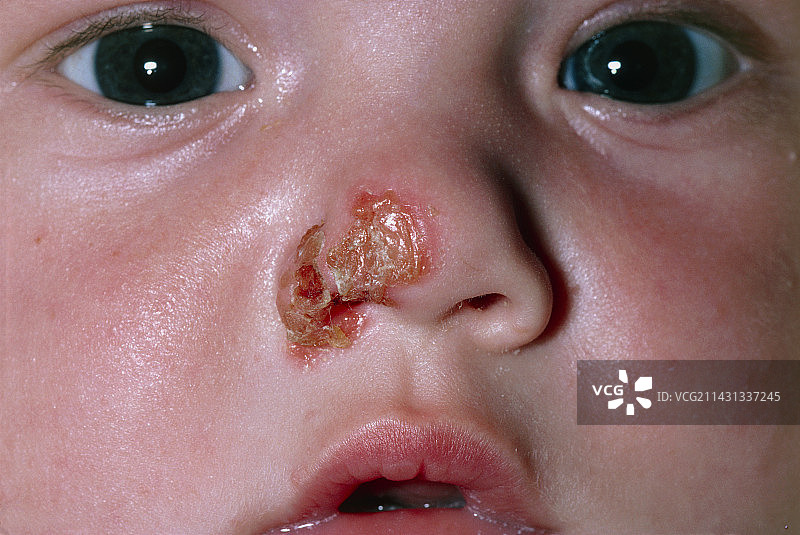 患有脓疱病的儿童图片素材