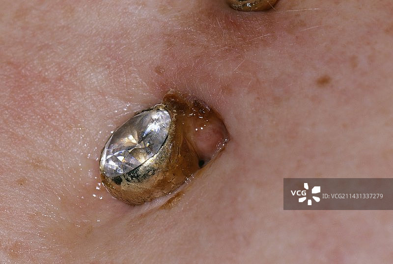 肚脐穿孔感染图片素材