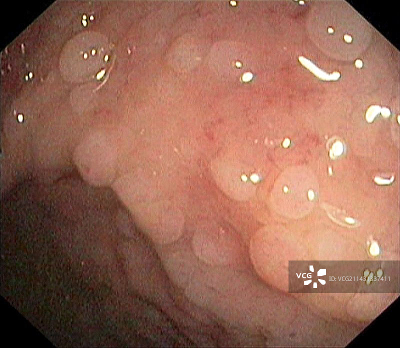 直肠息肉图片素材
