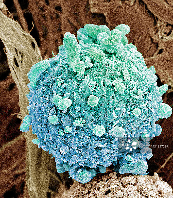 皮肤癌细胞，扫描电子显微镜图片素材