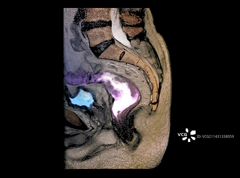 直肠癌核磁共振扫描图片素材