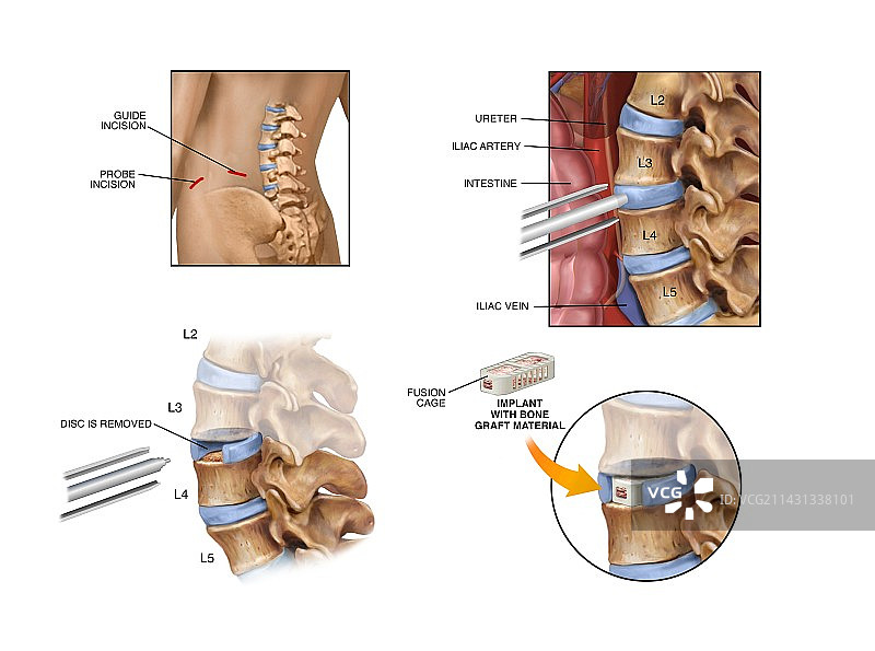 腰椎融合手术图片素材