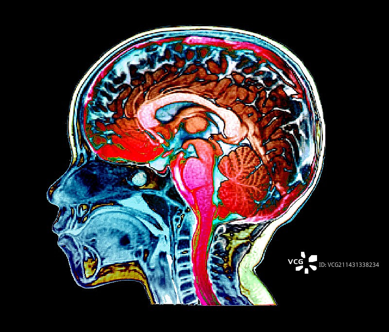 儿童头部和大脑的MRI扫描图片素材